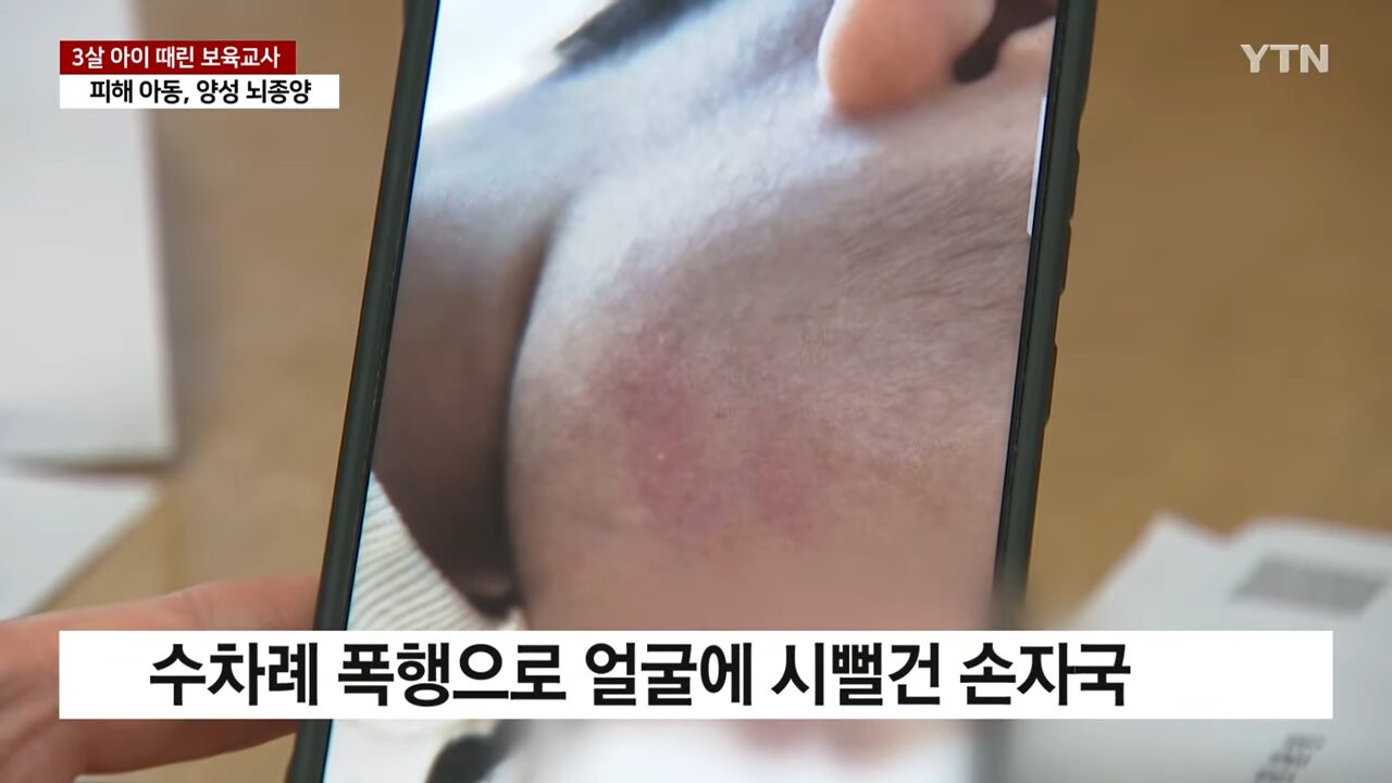 [단독] 뇌종양 3살 아이 때린 보육교사..._직무 스트레스_ _ YTN 1-4 screenshot