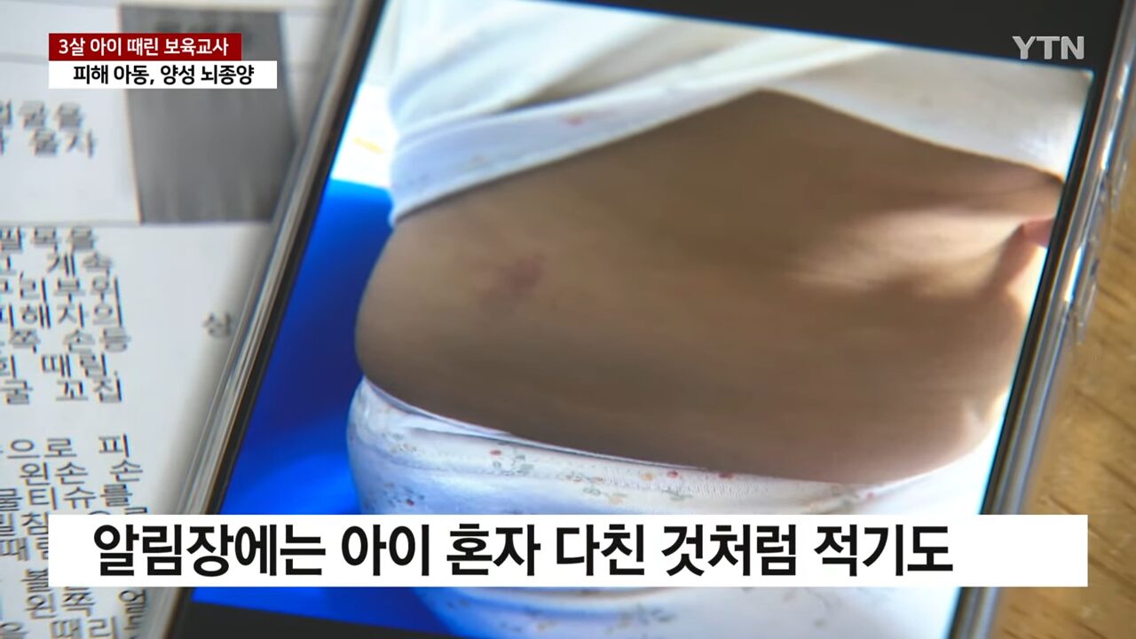[단독] 뇌종양 3살 아이 때린 보육교사..._직무 스트레스_ _ YTN 2-4 screenshot