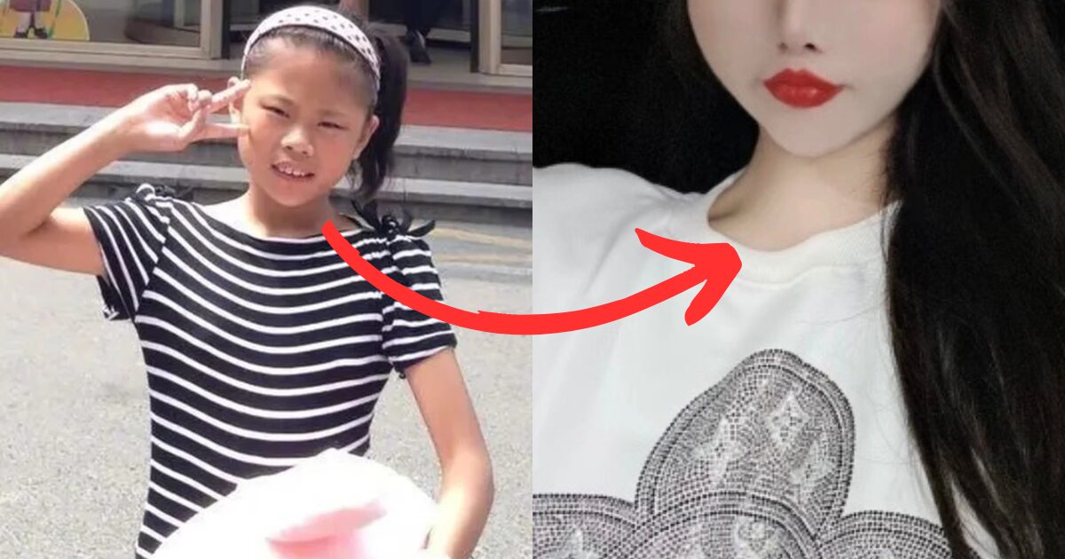 “Ruined Her Face” — The Controversial Decision To Allow A 13-Year-Old To Get Plastic Surgery
