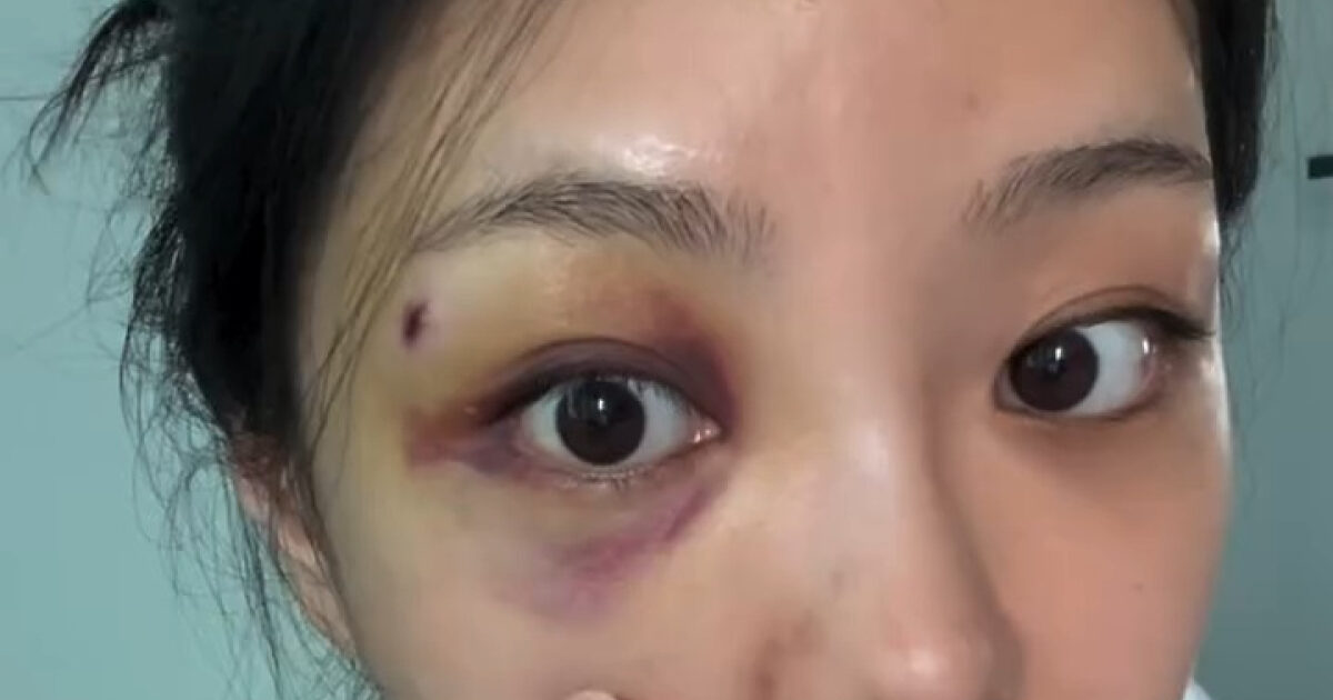 Reality Dating Show Star Addresses Rumors Surrounding Her Heavily Bruised Eye